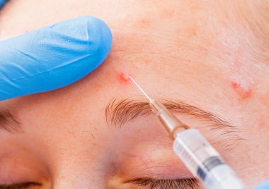 Acne treatment clipart