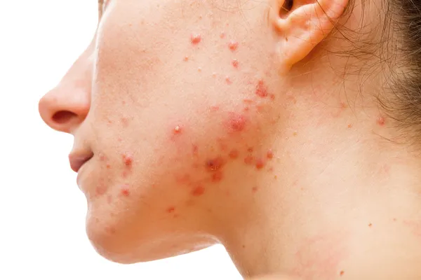 Acne huid — Stockfoto