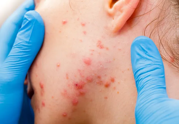 Acne huid — Stockfoto