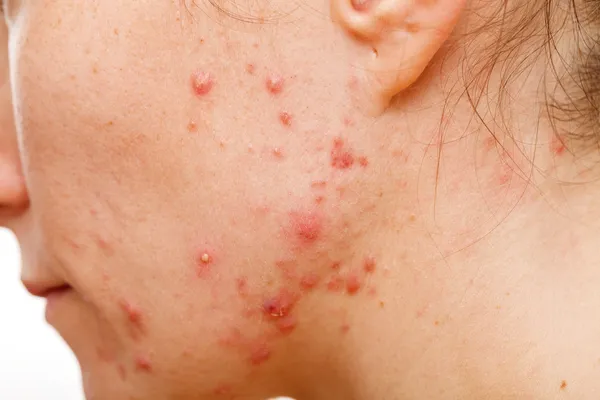 Acne huid — Stockfoto