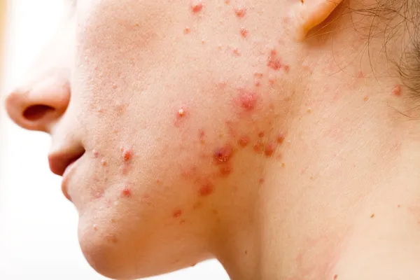 Acne skin — Stock Photo, Image