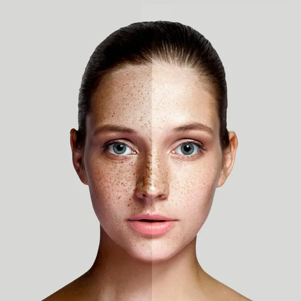Closeup Portrait Beautiful Woman Laser Treatment Removing Freckles Pigment Face — Stock Photo, Image