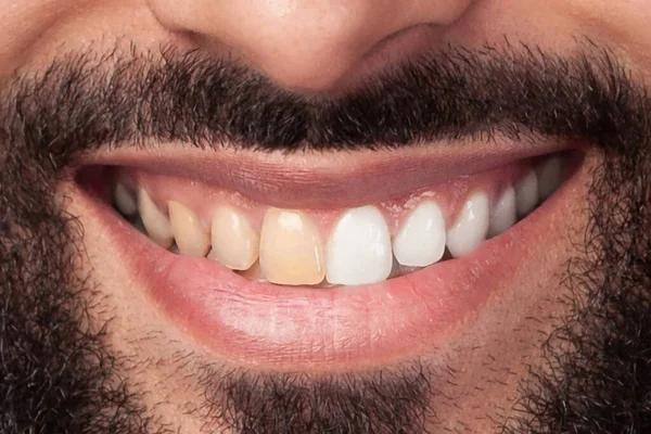 笑顔の男の白化や漂白の前と後の人の歯の閉鎖 歯の健康の概念 口腔ケアの概念 — ストック写真