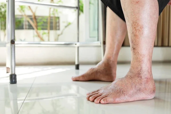 Closeup Asian Old Senior Swollen Feet Pain Numbness Ankle Leg — Fotografia de Stock