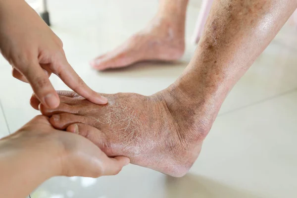 Hands Doctor Nurse Examining Dry Cracked Swollen Feet Old Elderly — Stockfoto