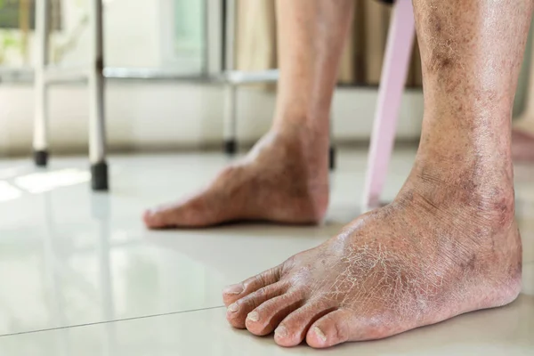 Closeup Foot Old Elderly Swollen Leg Dry Skin Feet Cracks — Stockfoto