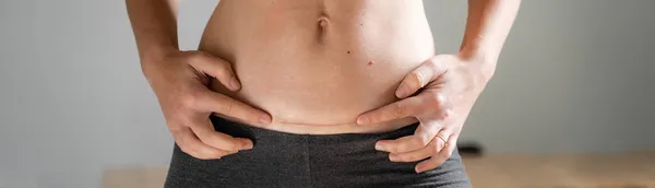 Mujer abdomen con cicatriz de cesárea. Hogar estilo de vida sincero. Cirugía de cesárea para mujeres embarazadas. Recuperación después del nacimiento. — Foto de Stock