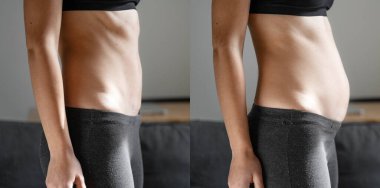 Genç kadın vücuduna bakmadan önce ve sonra. Karnı şişti. Hamilelik. Doğumdan sonra Diastasis Recti. Kilo vermek için spor ve diyet. 