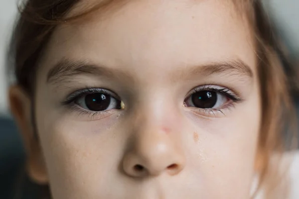 Close up de criança doente com conjuntivite, olho vermelho com pus — Fotografia de Stock