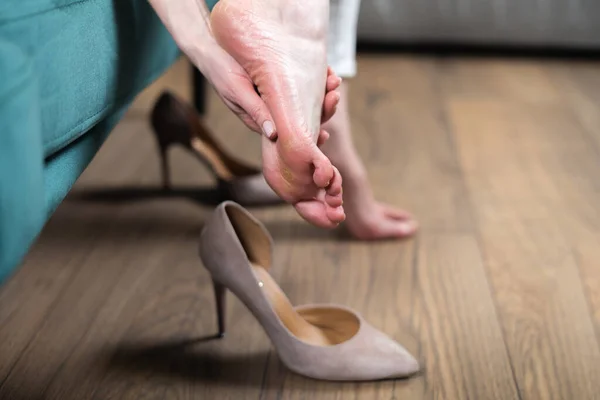 Feche de pés de mulher com calo. Mau problema de saúde dos sapatos errados. Dor nos pés — Fotografia de Stock