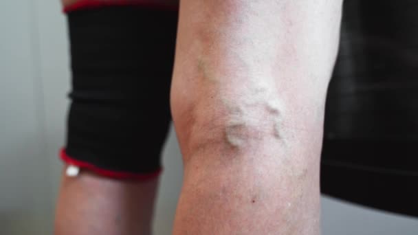 Close Leg Varicose Veins Close Woman Legs Vascular Disease High — Vídeo de Stock