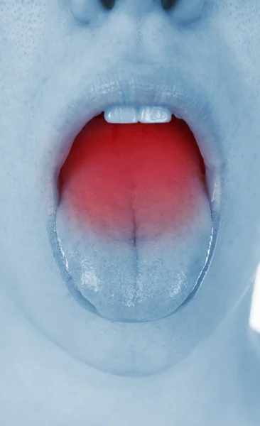 Sore throat, shown red — Stock Photo, Image