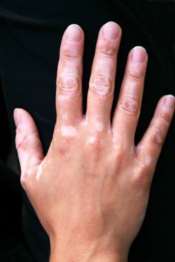 vitiligo deri durum yardım