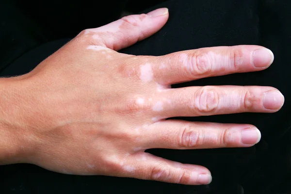 Een hand met vitiligo huidaandoening — Stockfoto