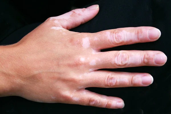 Een hand met vitiligo huidaandoening Rechtenvrije Stockafbeeldingen