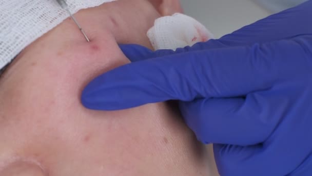 Closeup Thread Lift Injection Cheeks Nurse Wearing Blue Gloves — Stockvideo