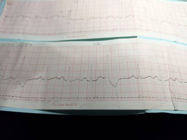 Kalp ritmi anormalliğini tanımlayan elektrokardiyogram veya EKG resmi, yani prematüre ventriküler kasılma veya PVC
