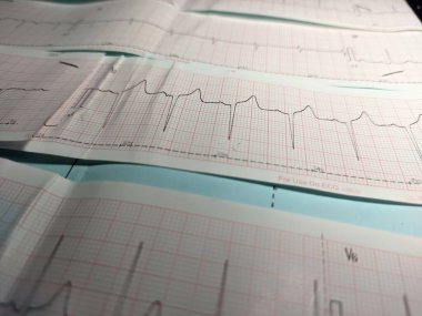 Kalp ritmi anormalliğini gösteren bir elektrokardiyogram ya da EKG, yani alt duvar iskemisi.