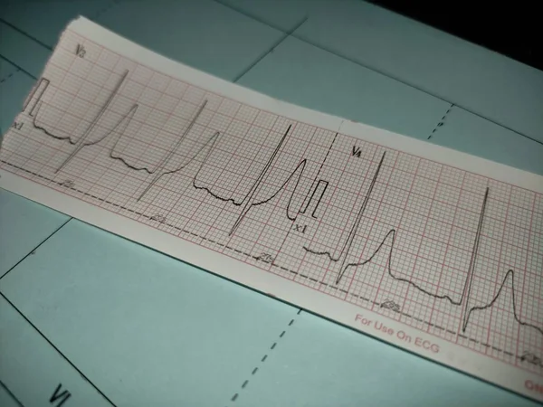 Electrocardiogram Ecg Picture Describes Heart Rhythm Abnormality Namely Tall Hyperacute — Stok fotoğraf