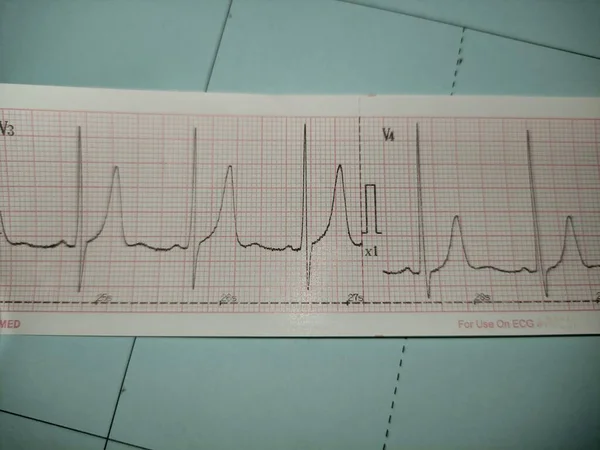 Electrocardiogram Ecg Picture Describes Heart Rhythm Abnormality Namely Tall Hyperacute — 图库照片