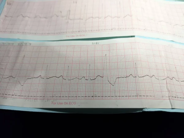 Electrocardiograma Cuadro Ecg Que Describa Una Anomalía Del Ritmo Cardíaco —  Fotos de Stock