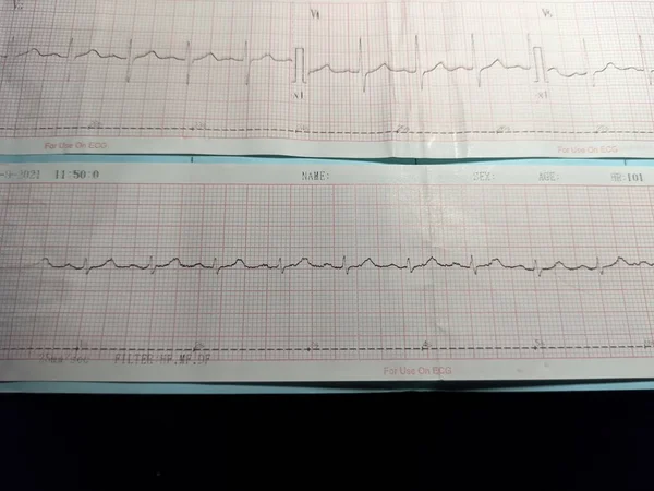 Electrocardiograma Ecg Que Represente Ritmo Cardíaco Saber Taquicardia Sinusal —  Fotos de Stock