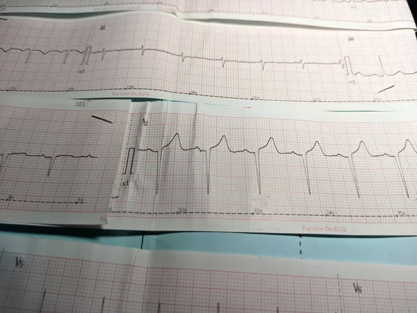 Electrocardiograma Ecg Que Represente Una Anomalía Del Ritmo Cardíaco Saber —  Fotos de Stock