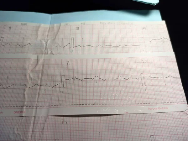 Electrocardiograma Ecg Que Representa Anomalías Del Ritmo Cardíaco Saber Bloqueo —  Fotos de Stock