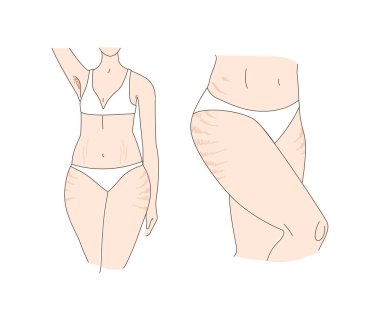 Woman and stretch marks, armpit hair. Wears white panties and bra. Vector illustration doodle in thin line art sketch style clipart