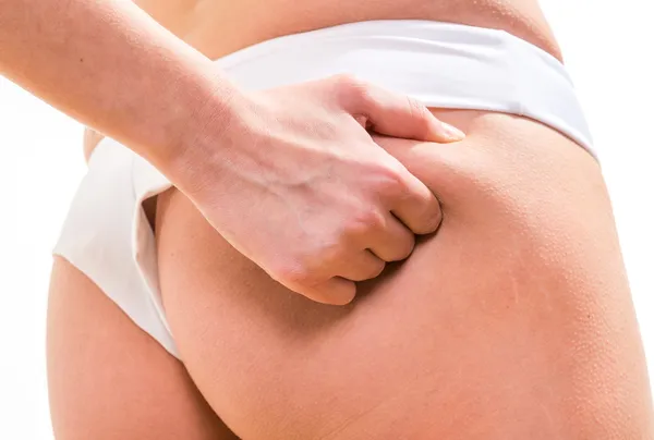 Kadın kalçasındaki selülitleri kontrol ediyor.