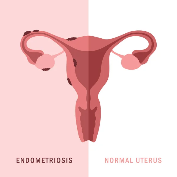 Endometriose e útero normal mulheres saúde anatomia info gráfico — Vetor de Stock