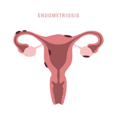 endometriosis info graphic womens health uterus anatomy clipart