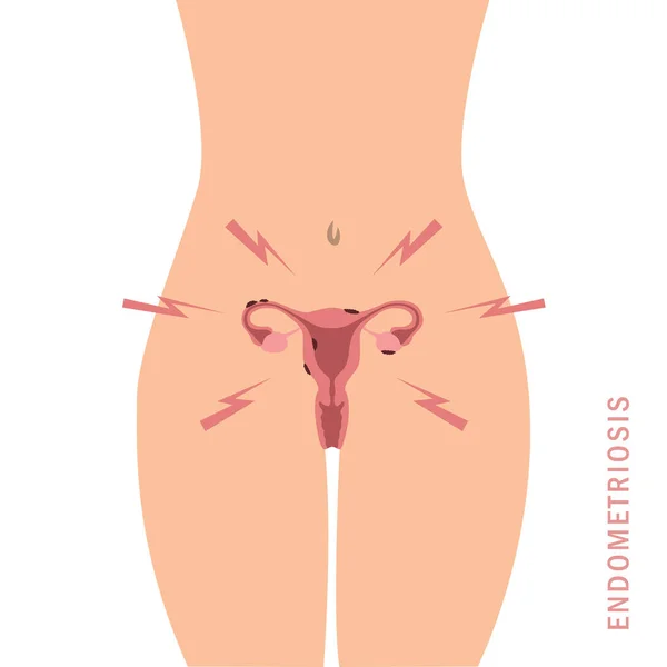 Ендометріоз інформація графічна жіноча анатомія матки здоров'я — стоковий вектор