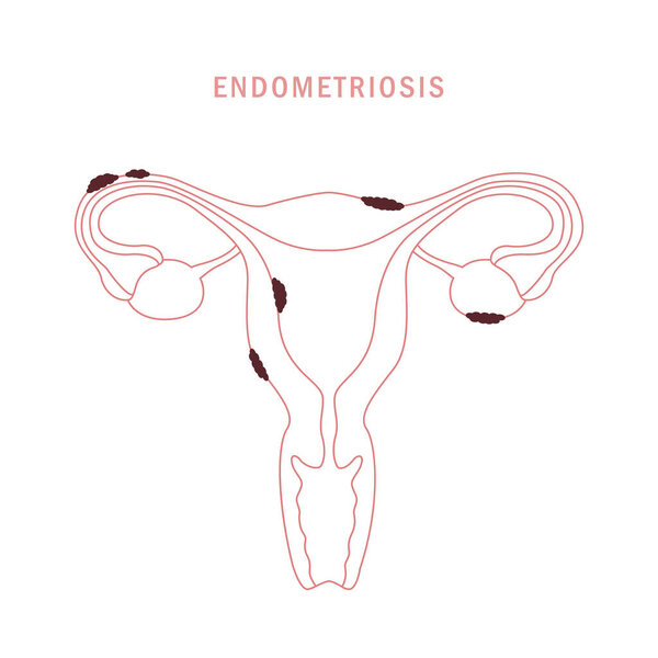 endometriosis info graphic womens health uterus anatomy