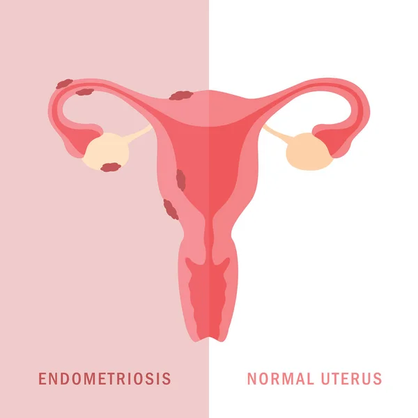 Endometriose und normaler Uterus Frauen Gesundheit Anatomie Info-Grafik — Stockvektor