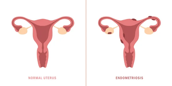 Endometriose und normaler Uterus Frauen Gesundheit Anatomie Info-Grafik — Stockvektor