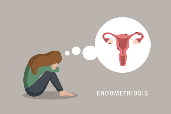 endometriosis and normal uterus womens health anatomy info graphic vector illustration EPS10