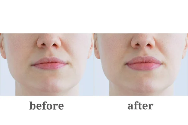 Augmentation Lips Caucasian Woman Cosmetological Injections — Stock Photo, Image