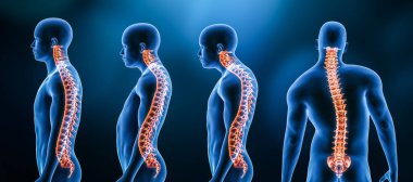 Omurga bozukluklarının ya da erkek vücudundaki deformasyonların üç ana eğriliği: lordosis, kyphosis ve skolyoz 3D çizim. İnsan anatomisi, sırt yaralanması veya hastalık, tıbbi kavramlar.