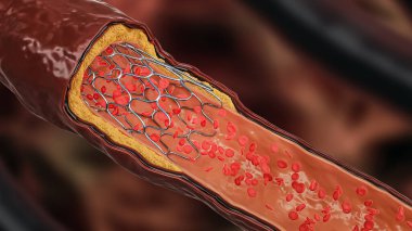 Anjiyoplasti 3 boyutlu çizim. Kolesterol ya da kan dolaşımlı atheroma plağıyla tıkanmış bir arter ya da kan damarı içine yerleştirilmiş stent. Cerrahi, tıp, kardiyoloji, sağlık, teknoloji, bilim kavramları.