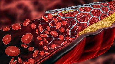 Anjiyoplasti 3 boyutlu çizim. Kolesterol ya da kan dolaşımlı atheroma plağıyla tıkanmış bir arter ya da kan damarı içine yerleştirilmiş stent. Cerrahi, tıp, kardiyoloji, sağlık, teknoloji, bilim kavramları.