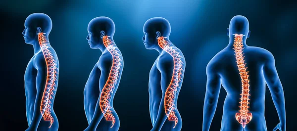 Omurga bozukluklarının ya da erkek vücudundaki deformasyonların üç ana eğriliği: lordosis, kyphosis ve skolyoz 3D çizim. İnsan anatomisi, sırt yaralanması veya hastalık, tıbbi kavramlar.