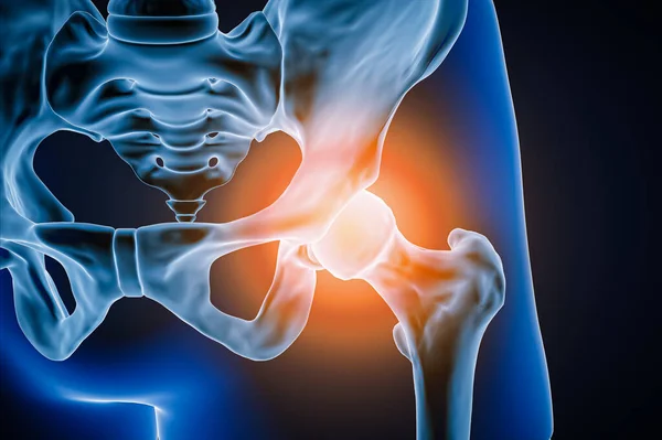 Vista Anterior Frontal Articulación Cadera Humana Los Huesos Con Inflamación — Foto de Stock