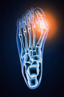 Hallux Valgus veya nasır 3D çizim. Mavi arka planda vücut hatları olan doğru insan sol ayak kemiklerinin üstün ya da sırt görüntüsü. Anatomi, osteoloji, pahtoloji, ortopedi konsepti.