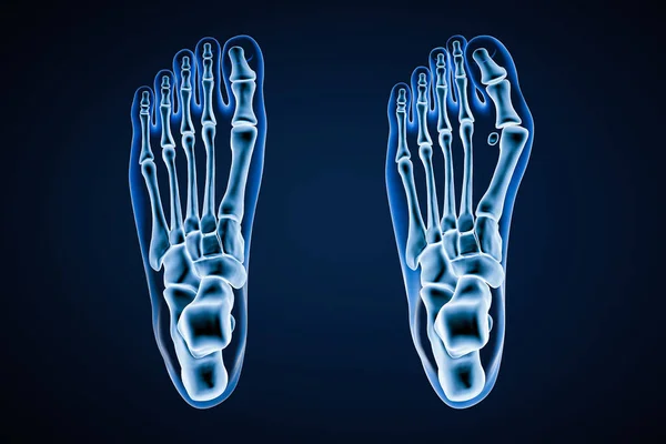 Halux ValgusまたはBunion Ray 3Dレンダリングイラスト 背の高い または人間の健康と負傷した左足の上の青の背景に表示されます 解剖学 病理学 整形外科の概念 — ストック写真