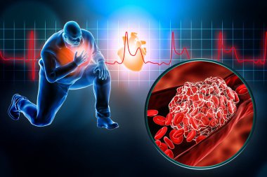 Kalp krizi ya da kan pıhtılaşması, trombüs ve STEMI EKG 3 boyutlu görüntüleme. Miyokardiyal enfarktüs, ilaç, tıbbi ve sağlık hizmetleri, kardiyovasküler hastalıklar.