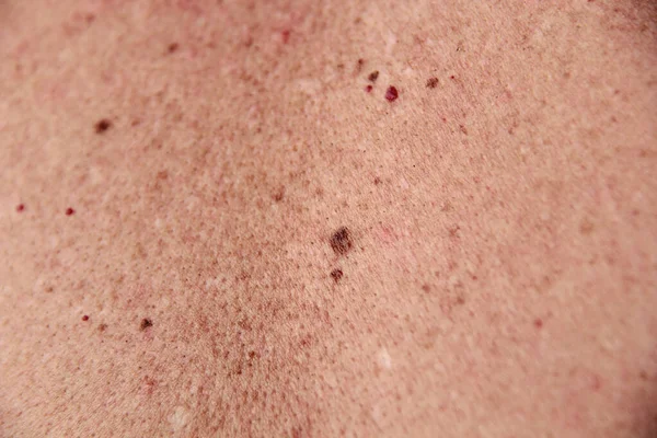 Skin Macro Close-up with Capillaries and Sun Spots, Moles. Red and Brown Skin Spots