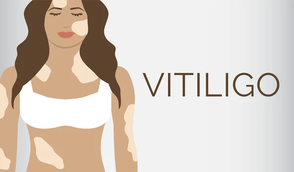 Vitligo Enfermedad Piel Banner Fondo — Vector de stock