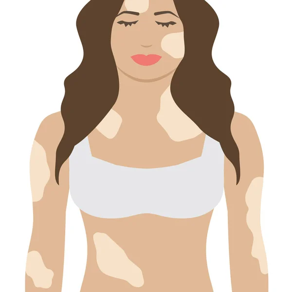 Mujer Con Vitiligo Ilustración Aislada — Vector de stock