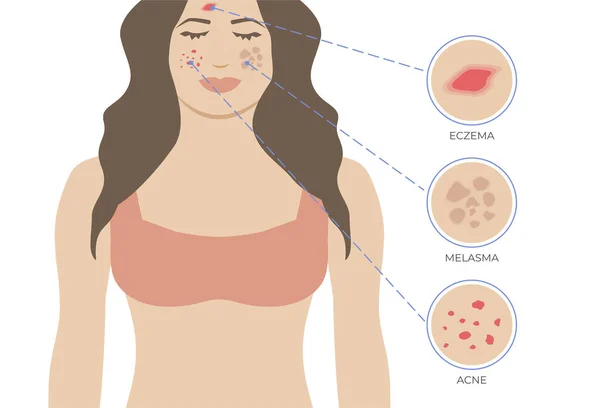 Problemas Pele Eczema Acne Melasma Problemas Pele Com Mulher Ilustração — Vetor de Stock